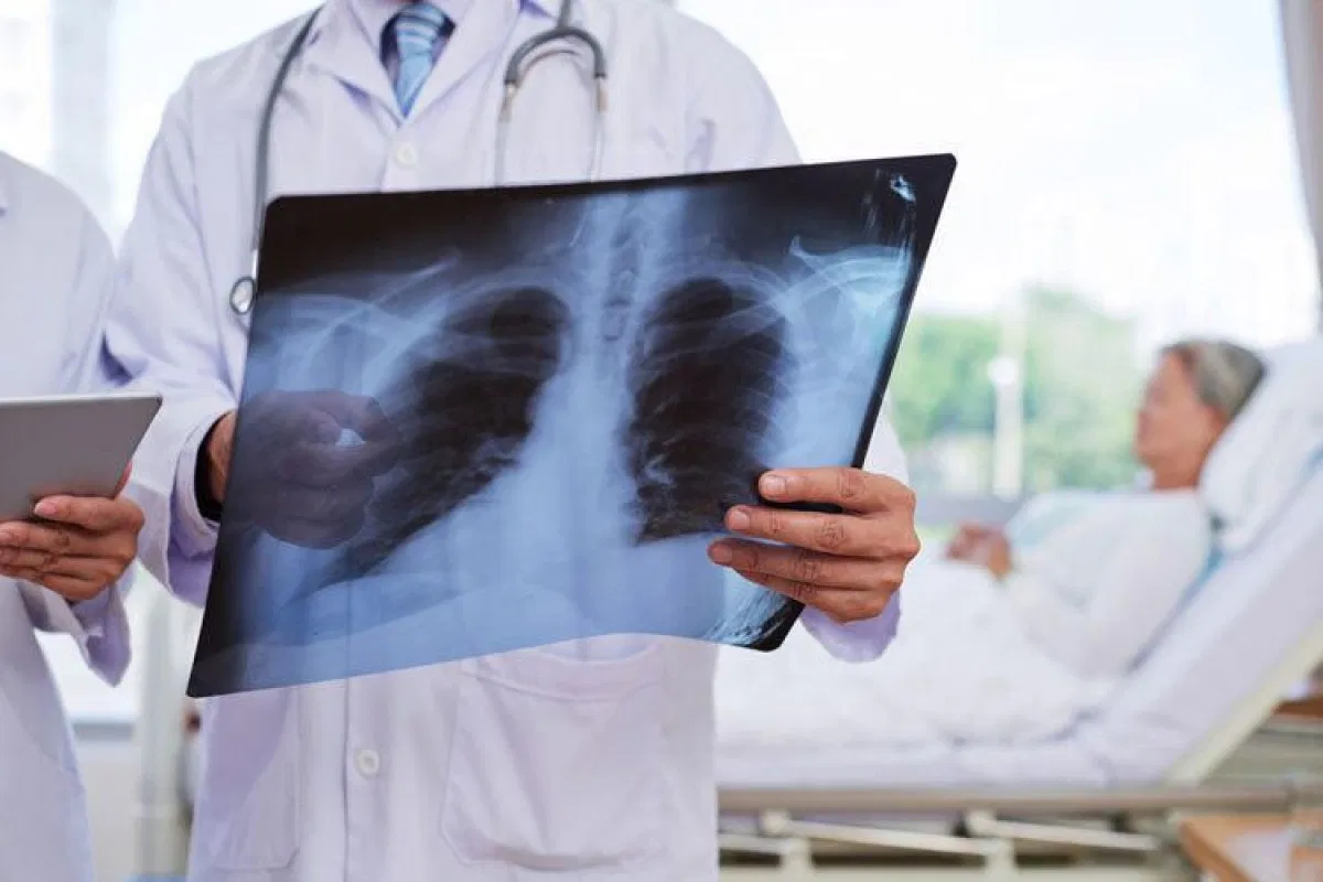 Key Differences Between Viral and Bacterial Pneumonia Explained
